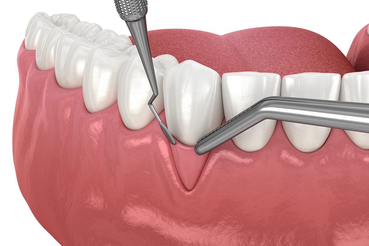 How to Care for Your Mouth After a Gum Graft Surgery
