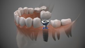 Diagram showing how dental implants in Belmont are placed