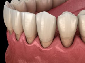 Illustration of gum recession exposing roots of a tooth 