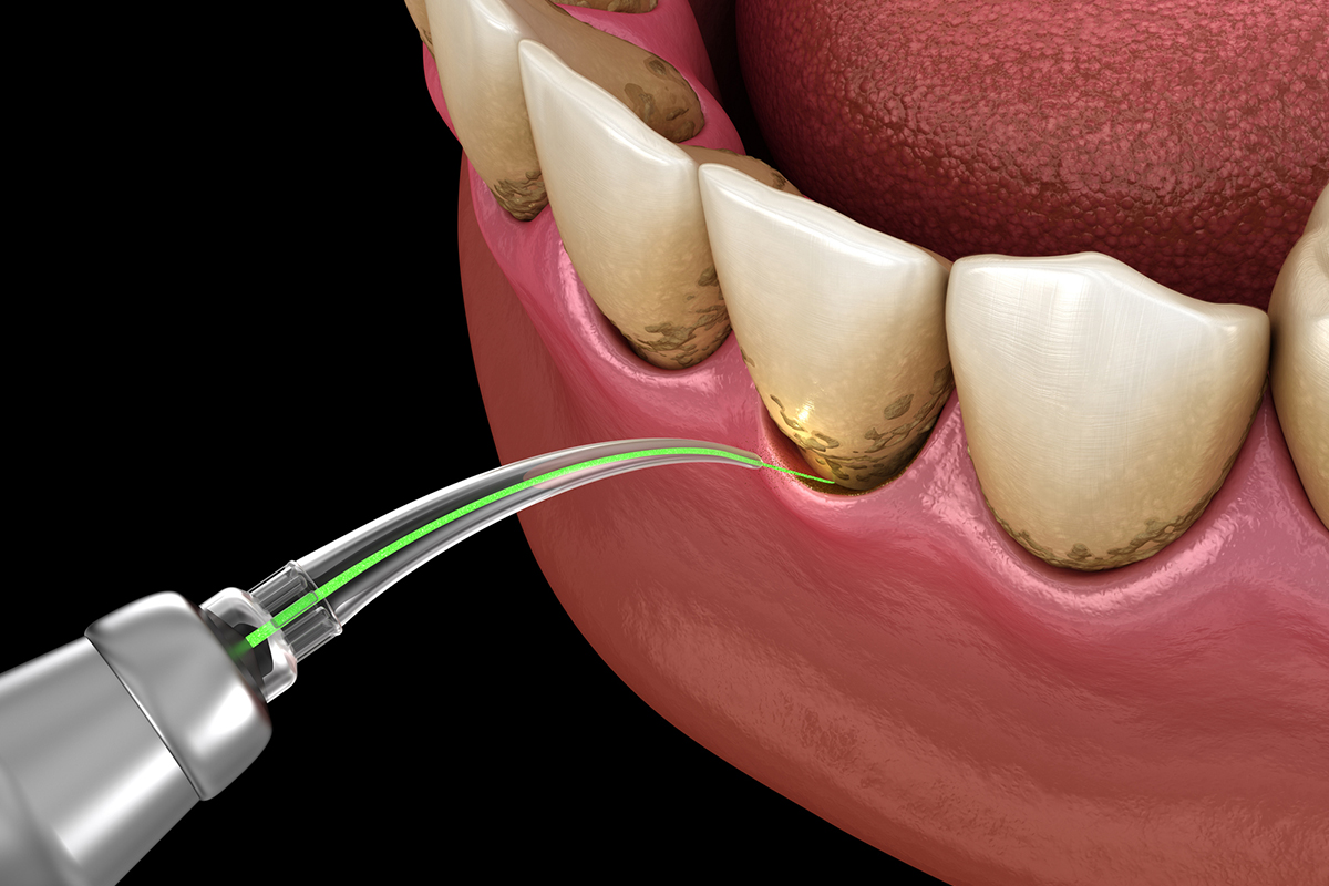 What Is a Frenectomy and Why Might You Need One?